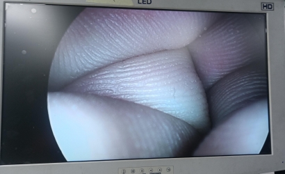 腹腔镜的组成及STORZ腹腔镜26003BA维修案例