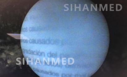 硬性输尿管镜的结构及Wolf输尿管镜8968.405的维修案例